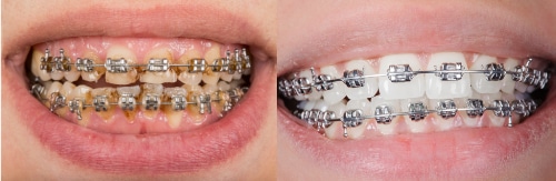 Proper verse Poor brushing results with braces