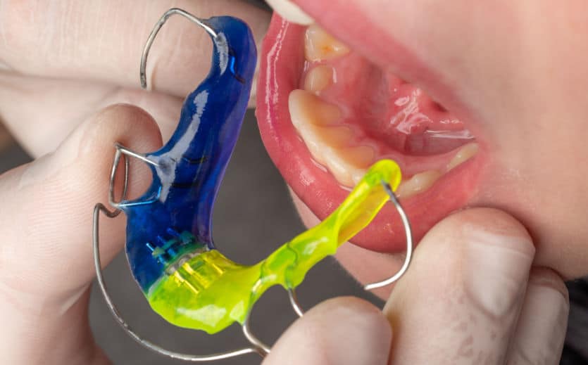 Using an Augusta Ortho Hawley retainer