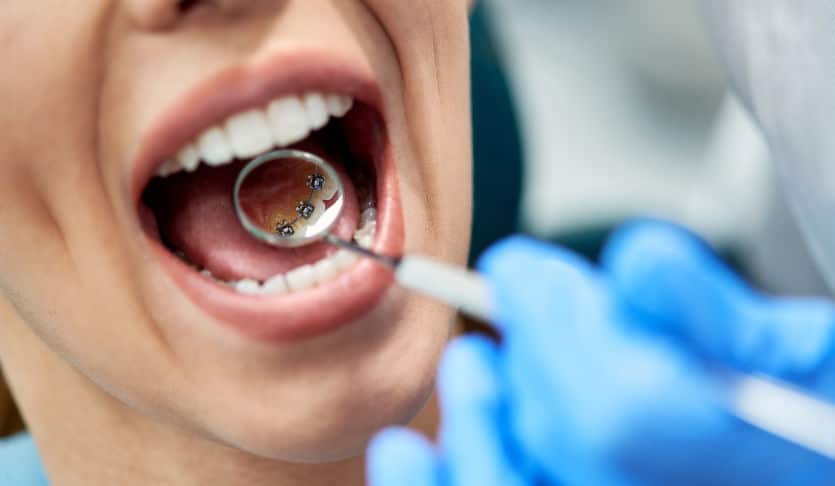 Permanent lingual retainers