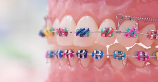 Braces Band Colors To Make Teeth Look Whiter