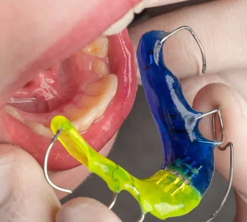Retainers for Kids