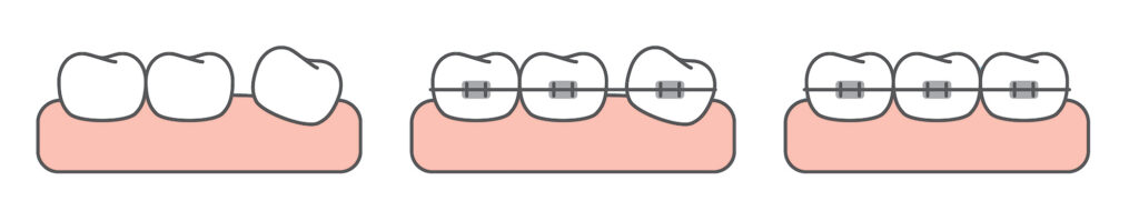 Stages of fixing teeth