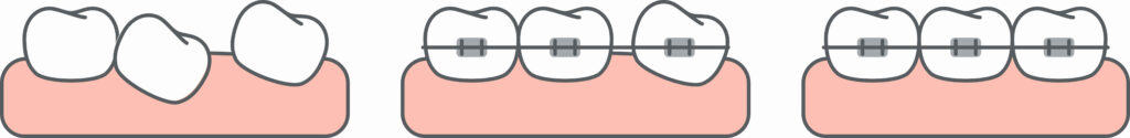 Braces make uniform back teeth