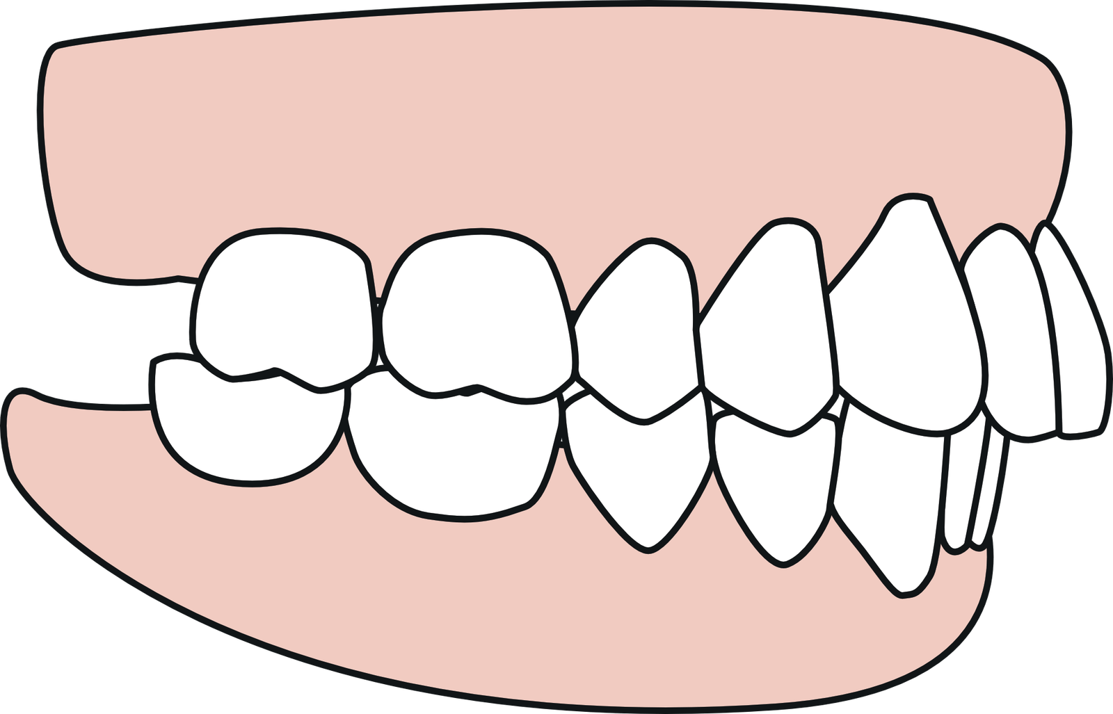 Teeth Pointing Out What To Do About Teeth That Stick Out Cleveland Cleveland Dental