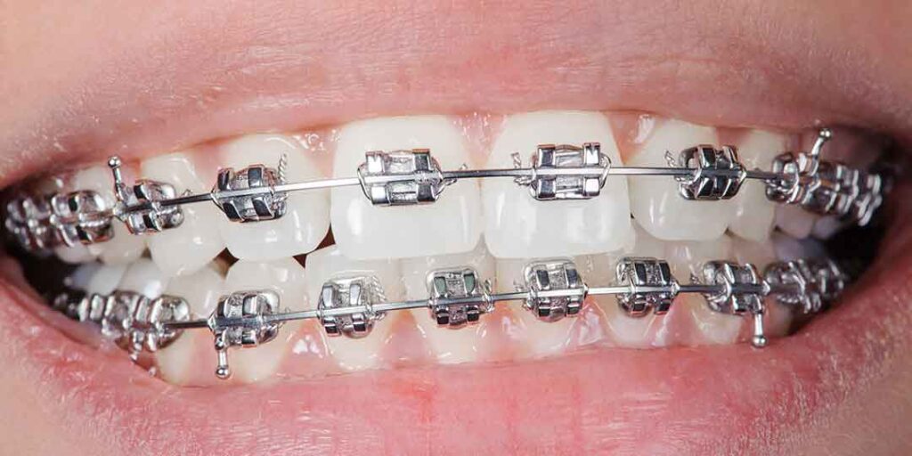 traditional metal braces cost