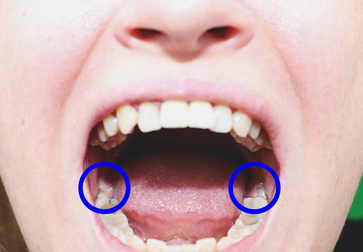 Wisdom Teeth 3rd Molars