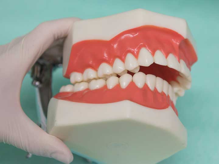 Types of open bite