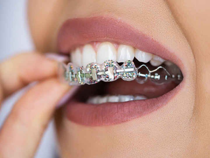 Fashion braces are popular but risky choice