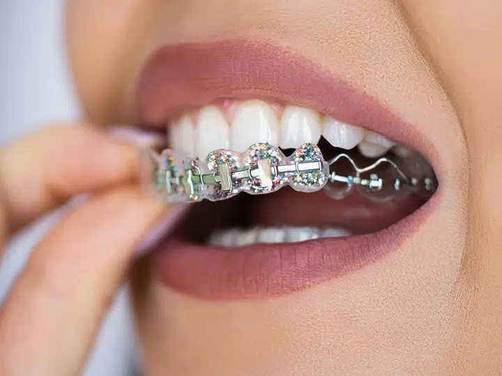 Fashion braces are popular but risky choice